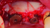 Fig 10: healing abutment placement with FGG; Fig 11: 2 months post-treatment.