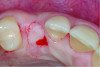 Fig 11: 2 months post-treatment.