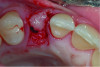 Fig 12 through Fig 14. Example of increasing MT with a roll technique. Fig 12: incision design for implant placement with a healing abutment placement and to enhance MT; the recipient site is prepared on the buccal side; the palatal aspect of the flap will be rolled to the buccal recipient site; Fig 13: insertion of roll of tissue taken from the palatal aspect of the flap; Fig 14: implant placement with healing abutment.