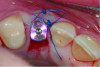 Fig 12 through Fig 14. Example of increasing MT with a roll technique. Fig 12: incision design for implant placement with a healing abutment placement and to enhance MT; the recipient site is prepared on the buccal side; the palatal aspect of the flap will be rolled to the buccal recipient site; Fig 13: insertion of roll of tissue taken from the palatal aspect of the flap; Fig 14: implant placement with healing abutment.