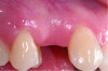 Fig 12 through Fig 14. Example of increasing MT with a roll technique. Fig 12: incision design for implant placement with a healing abutment placement and to enhance MT; the recipient site is prepared on the buccal side; the palatal aspect of the flap will be rolled to the buccal recipient site; Fig 13: insertion of roll of tissue taken from the palatal aspect of the flap; Fig 14: implant placement with healing abutment.