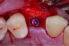 Fig 15 and Fig 16. Example of increasing MT with a CTG. Fig 15: buccal view of initial situation showing deficient mucosal thickness; Fig 16: occlusal view at implant placement with CTG.