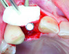 Fig 15 and Fig 16. Example of increasing MT with a CTG. Fig 15: buccal view of initial situation showing deficient mucosal thickness; Fig 16: occlusal view at implant placement with CTG.
