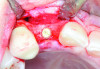 Fig 17 and Fig 18. Example of increasing MT with a CM. Fig 17: placement of CM at implant placement in the case presented in Fig 3 and Fig 5; Fig 18: occlusal view immediately after insertion of the CM.