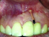 Fig 1 and Fig 2. Case 1: Initial clinical presentation with gutta-percha placed in the apical fistula of tooth No. 9 (Fig 1); radiograph showing gutta-percha point leading to the periapical lesion (Fig 2).