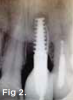 Fig 1 and Fig 2. Case 1: Initial clinical presentation with gutta-percha placed in the apical fistula of tooth No. 9 (Fig 1); radiograph showing gutta-percha point leading to the periapical lesion (Fig 2).