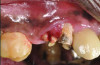 Fig 3 and Fig 4. Case 2: Initial clinical presentation showing implant No. 6 with RPI, having been impacted by fractured tooth No. 5 (Fig 3); radiograph showing fractured tooth No. 5 with periapical lesion extending to the distal aspect of implant No. 6 (Fig 4).