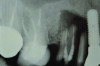 Fig 4. Case 2: Initial clinical presentation showing implant No. 6 with RPI, having been impacted by fractured tooth No. 5 (Fig 3); radiograph showing fractured tooth No. 5 with periapical lesion extending to the distal aspect of implant No. 6 (Fig 4).