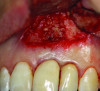 Fig 6. Case 1: FDBA bone allograft placed to fill the implant defect.
