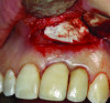 Fig 7. Case 1: Resorbable collagen membrane placed to cover the defect.