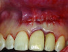 Fig 8. Case 1: Primary closure obtained using interrupted resorbable sutures.