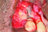 Fig 9. Case 2: Full-thickness flap reflection, extraction of tooth No. 5, debridement and cleaning of implant No. 6 with titanium scalers and titanium brush with doxycycline–saline slurry. Note extensive implant thread exposure approaching the apex. No mobility of the implant was noted.