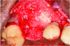 Fig 10. Case 2: FDBA bone allograft mixed with a small amount of doxycycline placed over the defect. The graft would be covered with a resorbable collagen membrane.