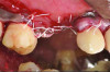 Fig 11. Case 2: Primary closure achieved using ePTFE sutures.