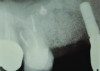 Fig 12. Case 2: Immediate postoperative radiograph. Note the tack securing the collagen membrane (upper left portion of the image).