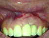 Fig 13 and Fig 14. Case 1: Facial view (Fig 13) and radiograph (Fig 14) at 12-month follow-up confirming resolution of the RPI.