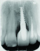 Fig 14. Case 1: Facial view (Fig 13) and radiograph (Fig 14) at 12-month follow-up confirming resolution of the RPI.