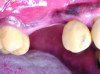 Fig 15 and Fig 16. Case 2: Clinical view (Fig 15) and radiograph (Fig 16) at 12-month follow-up confirming resolution of the peri-implant defect.