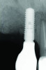 Fig 16. Case 2: Clinical view (Fig 15) and radiograph (Fig 16) at 12-month follow-up confirming resolution of the peri-implant defect.