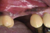 Fig 17 and Fig 18. Case 2: Clinical view (Fig 17) and radiograph (Fig 18) at 7-year follow-up confirming stable peri-implant bone.