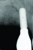Fig 18. Case 2: Clinical view (Fig 17) and radiograph (Fig 18) at 7-year follow-up confirming stable peri-implant bone.