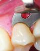 Fig 4. The clamp seating has been corrected under magnification and the marginal gingiva thus protected.