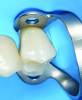 Fig 8. Full marginal coverage has been achieved under magnification.
