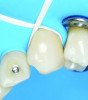 Fig 10. Dental floss is utilized to invert the rubber dam cuff subgingivally.