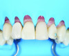 Fig 15. After treatment is finished and floss ligatures have been removed, the rubber dam is pulled to expose soft tissue and identify safe points that can be cut with scissors.