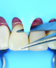 Fig 16. Under the DOM, the rubber dam cutting point can be precisely identified to prevent injury to intraoral soft tissues. Note that with the use of the enhanced microscopic vision there is no need to place a finger beneath the dam.