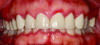 Fig 1. Erosive lichen planus in a 47-year-old African American female patient. Erythematous, ulcerated lesions could be visualized at the gingival margin in both the maxilla and mandible. The patient reported significant discomfort associated with these lesions and aversions to acidic and hot foods due to pain after consumption.