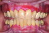 Fig 2. Mucous membrane pemphigoid in a 76-year-old Caucasian female patient. Erythematous desquamative lesions were present in both the maxilla and mandible on the gingival tissues. This patient presented with intermittent development of desquamation throughout the keratinized gingiva and reported discomfort associated with ulcerations and desquamation. The patient was sensitive to friction, including oral hygiene measures and mastication.