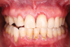 Fig 3. Pemphigus vulgaris in a 51-year-old Asian Indian female patient. This patient presented with an established diagnosis of PV at dermatologic and genital mucosal sites. She was taking oral immunologic modifiers prescribed by a rheumatologist prior to her examination in the periodontology clinic. Upon presentation, the patient demonstrated multiple ulcerated lesions at gingival tissues. The anterior mandible was the most affected area with marginal ulcerations and fibrin clot present. The patient reported difficulty in delivery of oral hygiene and in oral nutrition.