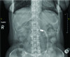 Fig 1. An abutment driver has been lodged in the patient’s fundus. An attempt to endoscopically remove the dental instrument resulted in the esophagus being perforated, leading to open surgery to repair the perforation.