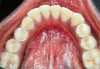 Fig 8. Lingual attached gingiva in a female subject: Fig 7 = left side, Fig 8 = middle, Fig 9 = right side.