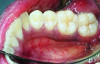 Fig 9. Lingual attached gingiva in a female subject: Fig 7 = left side, Fig 8 = middle, Fig 9 = right side.
