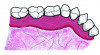 Fig 10. Schematics of the relative widths of lingual attached gingiva. Fig 10 = left side, Fig 11 = right side. The dark red area represents