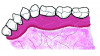 Fig 11. Schematics of the relative widths of lingual attached gingiva. Fig 10 = left side, Fig 11 = right side. The dark red area represents