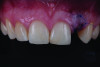 Fig 3. Clinical view of the edentulous site following extraction of the deciduous left lateral incisor and soft-tissue augmentation.