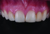 Fig 4. Interim removable partial denture inserted following connective tissue grafting to support the healing tissues and maintain the pontic site contour.