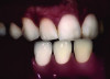 Fig 7. Shade selection and communication with the dental laboratory to ensure accurate color matching of the planned restoration to the adjacent natural dentition.