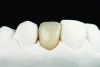 Fig 9. Facial view of the zirconia cantilever RBFDP on the working model, demonstrating the pontic design and overall esthetic proportions.