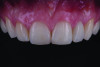 Fig 15. Postoperative intraoral frontal view showing the definitively bonded zirconia cantilever RBFDP in situ, with natural-appearing white and pink esthetics.