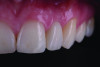 Fig 16. Postoperative view of the completed restoration demonstrating esthetic integration with the adjacent dentition, including color, shape, and surface texture.