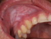 Fig. 3 White lesion in the right buccal vestibule.