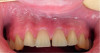 Fig 4.
White-line lesion under the right area of the maxillary buccal mucosa. (Images
from Miluna-Meldere S, Vanka SA, Skadins I, et al. <em>Diagn Pathol</em>.
2024;19(1):127.<sup>8</sup> Creative Commons license:
http://creativecommons.org/licenses/by-nc-nd/4.0/)