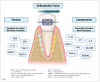 Fig 1. Compression and tension sides during orthodontic tooth movement. (Figure created by the authors using Biorender.com)