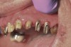 Figure 1  Patient following insertion of first set of implant custom abutments.