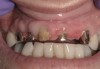 Figure 20 Implants and their respective subsequent abutments placed at Nos. 7 and 9.