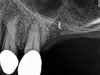 Fig 1. Radiograph of gutta percha placed at the base of the initial osteotomy with a round bur to verify location.